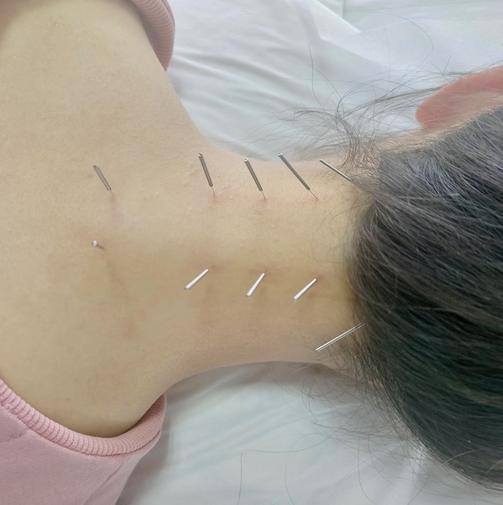 Acupuncture Richmond Hill